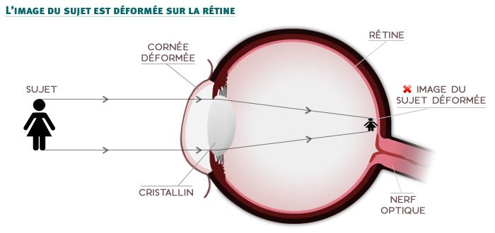L'astigmatisme - déformation de la courbure de la cornée