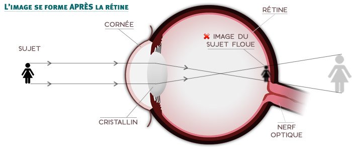 L'hypermétropie - l'image se forme après la rétine