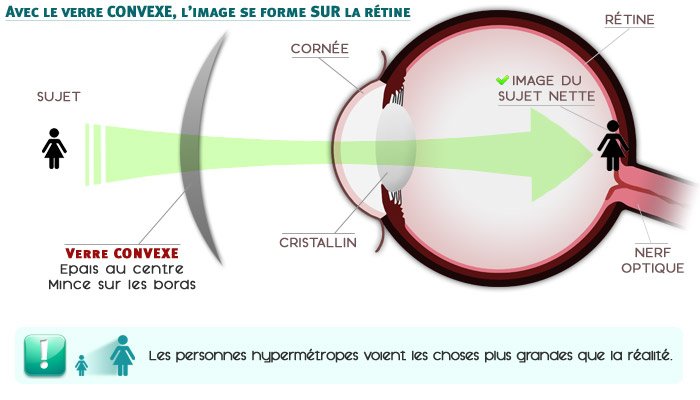 L'hypermétropie corrigée