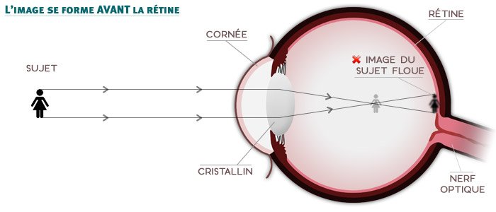 La myopie - schéma - l'image se forme avant la rétine