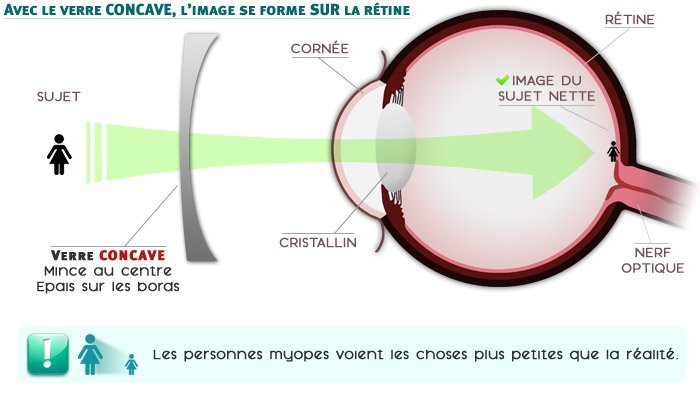 La myopie corrigée